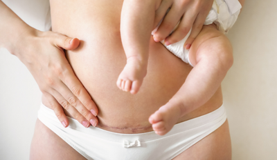 5 Things You Should Know About C-Section Recovery