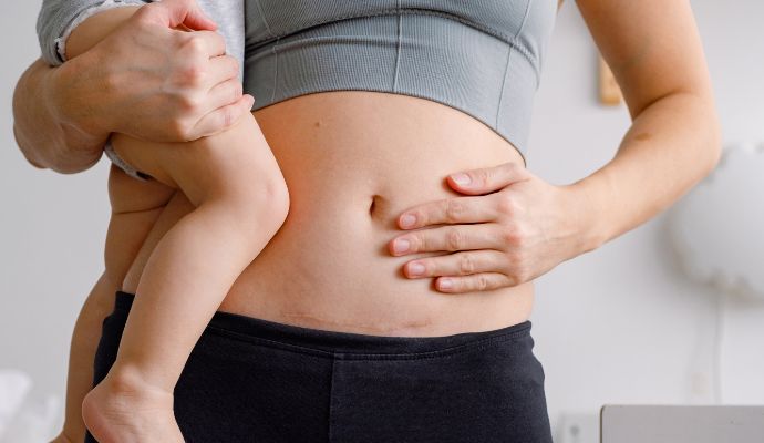 Helpful C-Section Recovery Tips New Moms Need to Know